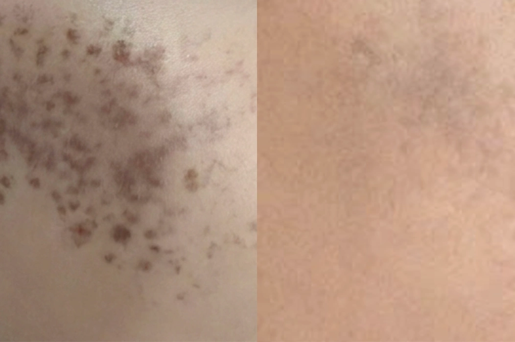 Hình minh họa: Xung laser điều trị vết bớt trên má bé trai