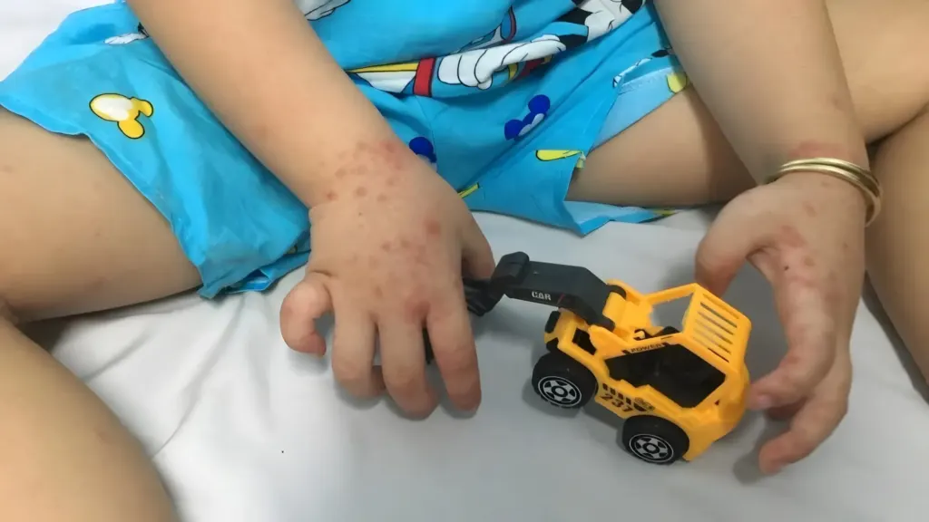 Hình minh họa: 5 dấu hiệu dễ bị hiểu nhầm khi trẻ mắc tay chân miệng