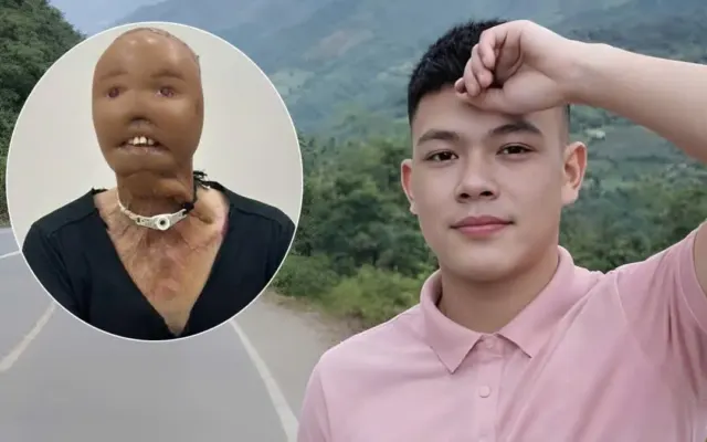 Hành trình tìm lại diện mạo của chàng trai mất mặt vì nước sôi