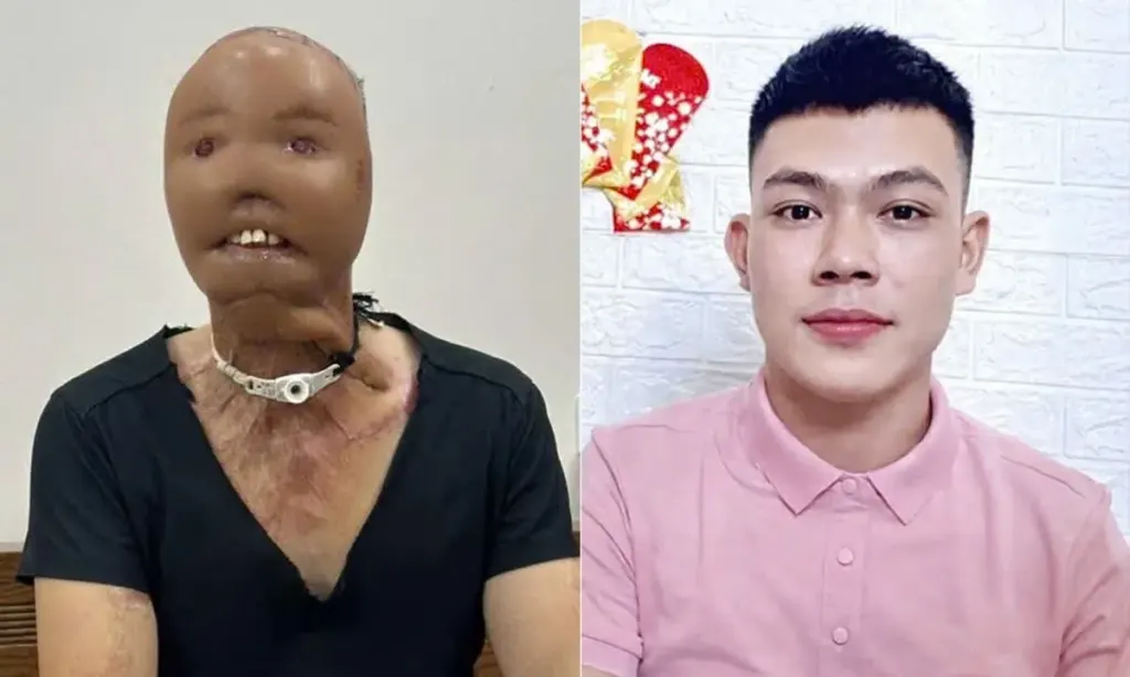 Hình minh họa: Hành trình tìm lại diện mạo của chàng trai mất mặt vì nước sôi