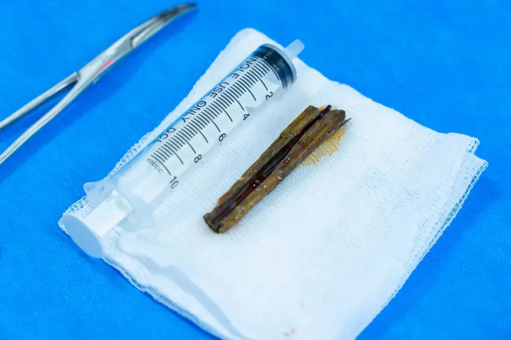 Hình minh họa: Mảnh tre dài 10 cm nằm 3 tháng trong cổ người đàn ông