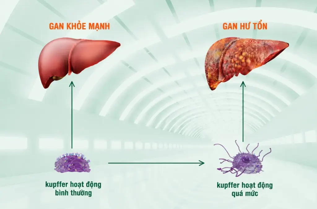 Hình minh họa: U gan không triệu chứng
