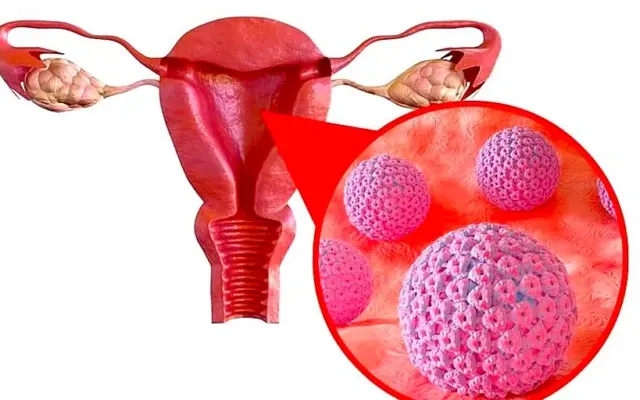 Ung thư cổ tử cung âm thầm đe dọa sức khỏe phụ nữ