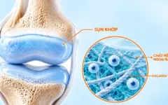 5 dấu hiệu sụn khớp suy yếu