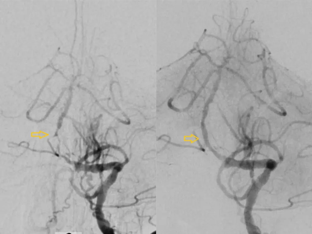 Hình minh họa: Đột quỵ tái phát, đặt stent tái thông mạch máu não