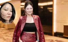 Bốn năm chữa mặt biến dạng vì mũi tiêm meso ‘trôi nổi’