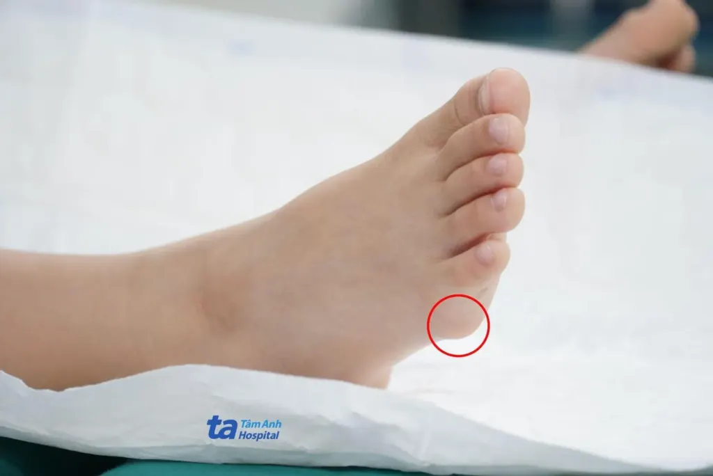 Hình minh họa: Kén thượng bì dưới bàn chân bé trai