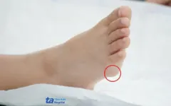 Kén thượng bì dưới bàn chân bé trai