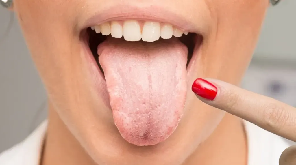 Hình minh họa: 3 dấu hiệu trên lưỡi có thể tiết lộ sức khỏe mạch máu