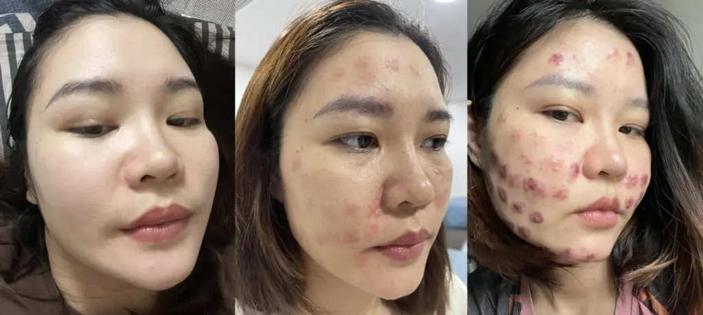 Hình minh họa: Bốn năm chữa mặt biến dạng vì mũi tiêm meso ‘trôi nổi’