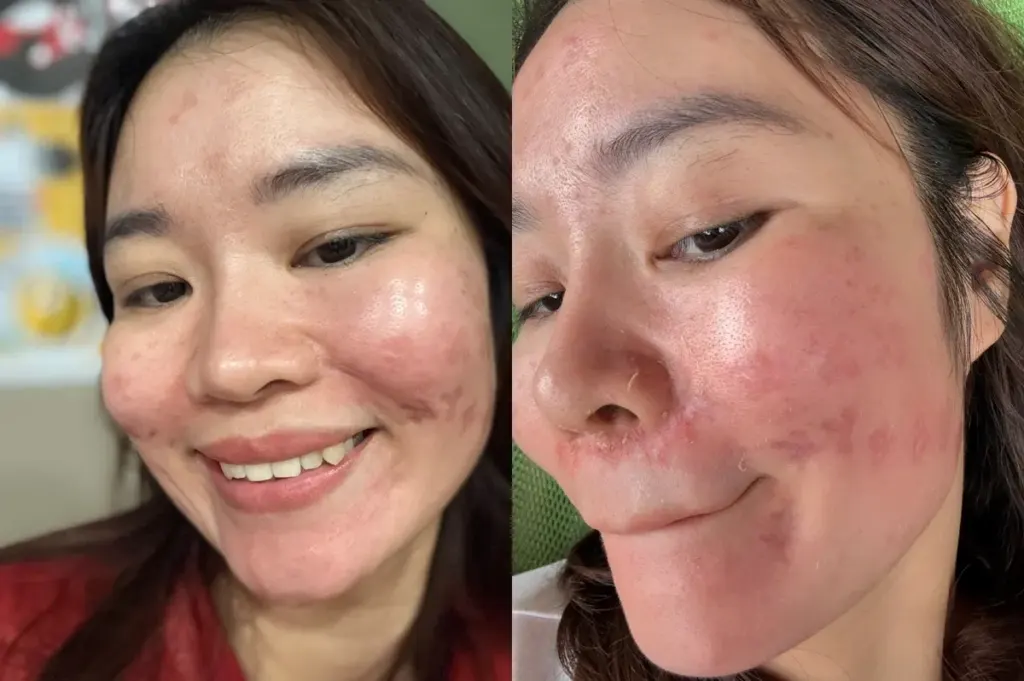 Hình minh họa: Bốn năm chữa mặt biến dạng vì mũi tiêm meso ‘trôi nổi’