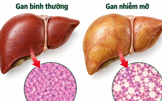 Men gan bình thường là dấu hiệu gan khỏe?