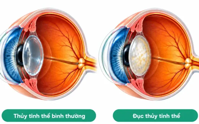 Thủy tinh thể lão hóa như thế nào theo tuổi tác?