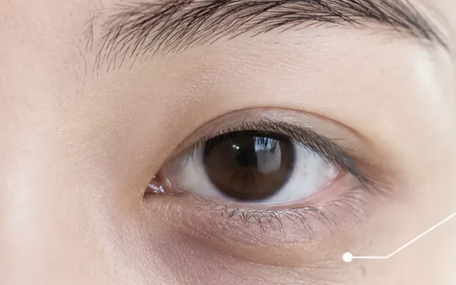 Vì sao bọng mắt xuất hiện?