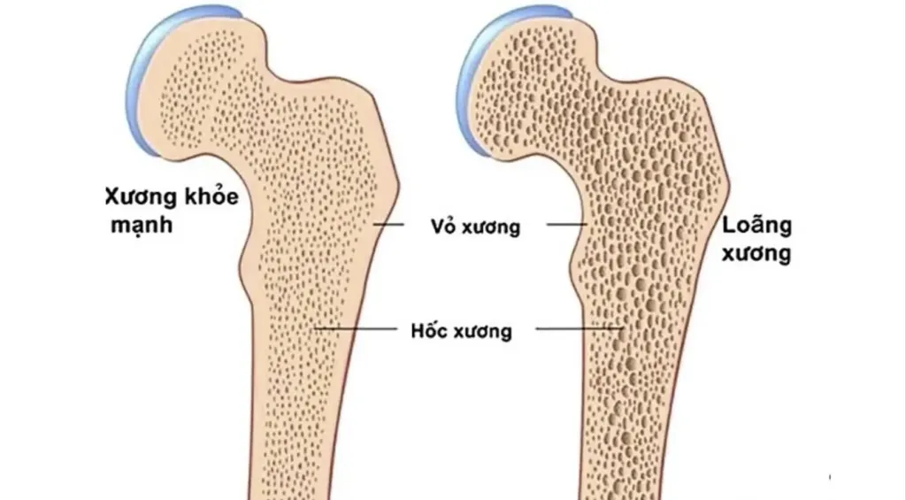 Hình minh họa: Loãng xương – mối nguy âm thầm rình rập phụ nữ sau tuổi 40