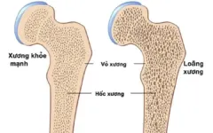 Loãng xương – mối nguy âm thầm rình rập phụ nữ sau tuổi 40