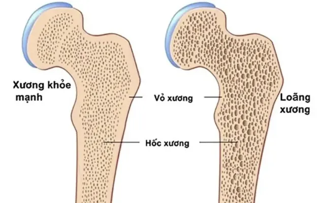 Loãng xương – mối nguy âm thầm rình rập phụ nữ sau tuổi 40