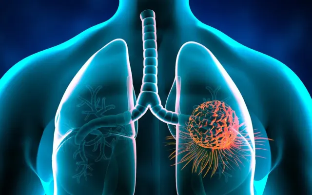 Tưởng rối loạn tiền đình, hóa ung thư phổi di căn não
