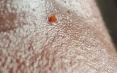 Mắc sùi mào gà ở mí mắt