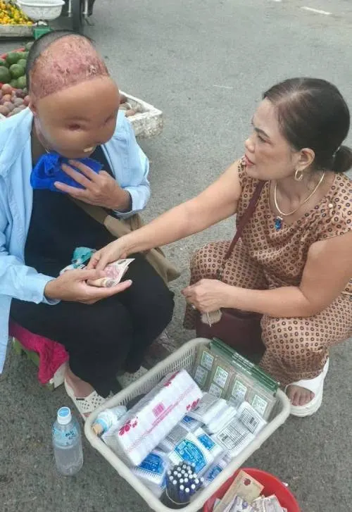 Hình minh họa: Hành trình tìm lại diện mạo của chàng trai mất mặt vì nước sôi