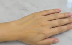Dấu hiệu nhận biết viêm gan do rượu
