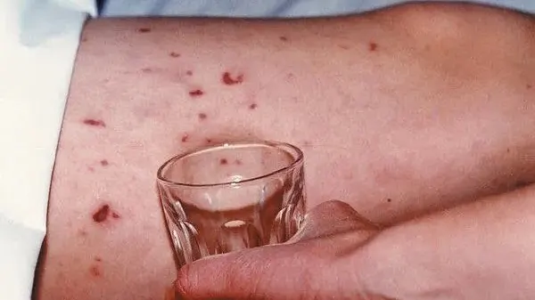 Vì sao ca não mô cầu có thể xuất hiện rải rác trong cùng khu vực?